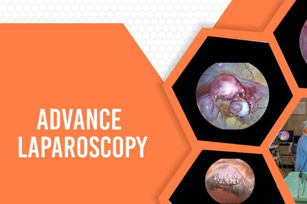Laparoscopy